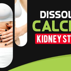 How to Dissolve Calcium Kidney Stones (Renal Calculi) Naturally 🍋🍷👌