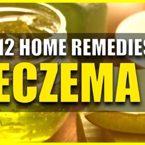 Top 12 home remedies of Eczema ||Remedies for Eczema || Things You Must Know To Get Rid of Eczema