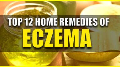 Top 12 home remedies of Eczema ||Remedies for Eczema || Things You Must Know To Get Rid of Eczema