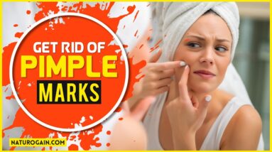 How to Get Rid of Acne, Pimples Marks Fast Naturally From Face at Home