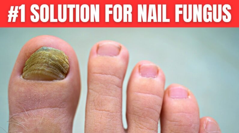 You Need Only 2 Ingredients To Get Rid of Nail Fungus Completely